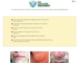 Cold Sore Treatment – How to Get Rid of Cold &hellip;